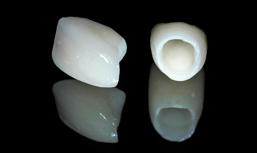 Răng toàn sứ được làm hoàn toàn từ sứ nguyên chất