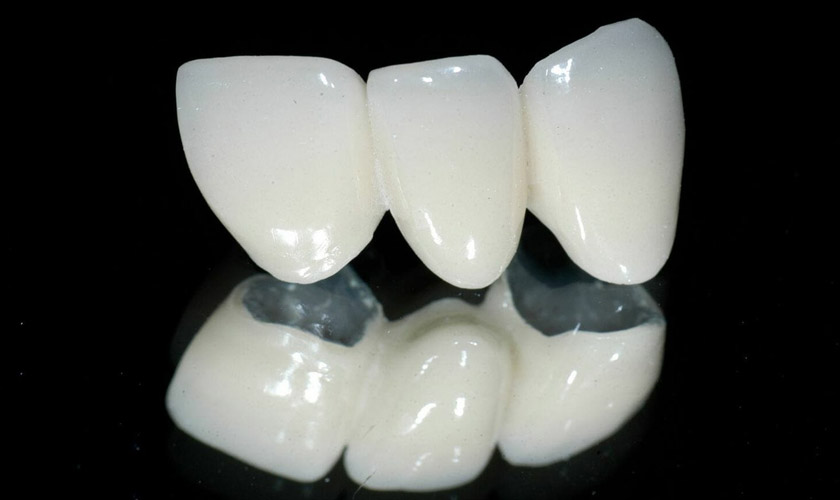 Răng sứ Titan có lõi hợp kim Niken-Crom-Titan ở bên trong, bên ngoài thì được phủ lớp men sứ Ceramco3