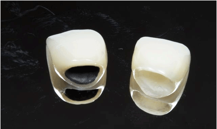 Bọc răng sứ giá bao nhiêu