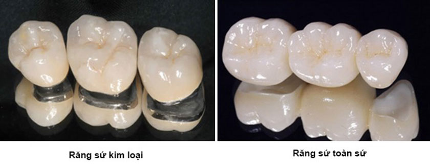 Bọc răng sứ thẩm mỹ