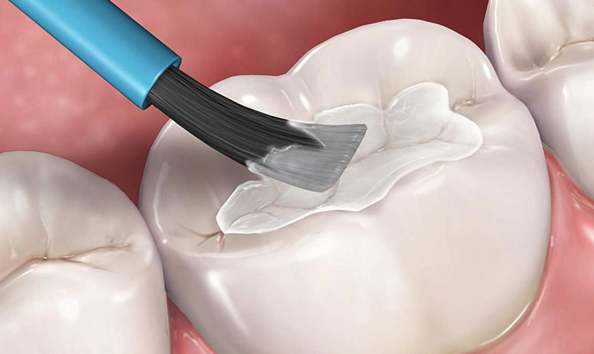 Các giai đoạn của sâu răng