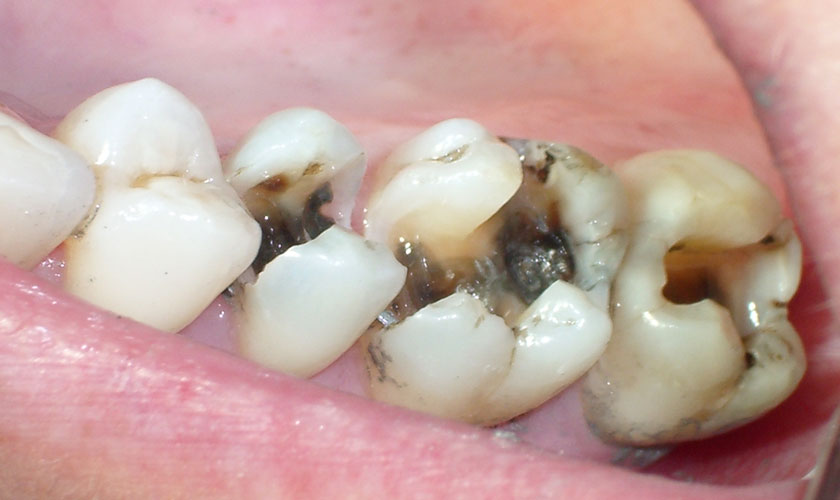 Răng bị sâu gây hôi miệng