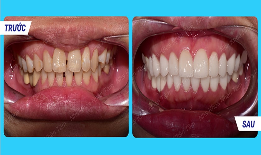 boc-rang-su-chat-luong