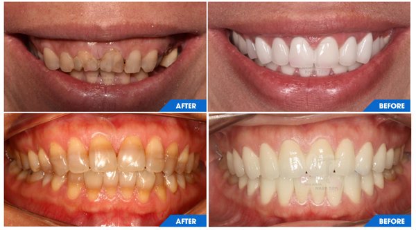 Làm răng sứ thẩm mỹ tại Nha khoa Nhân Tâm có gì khác biệt?