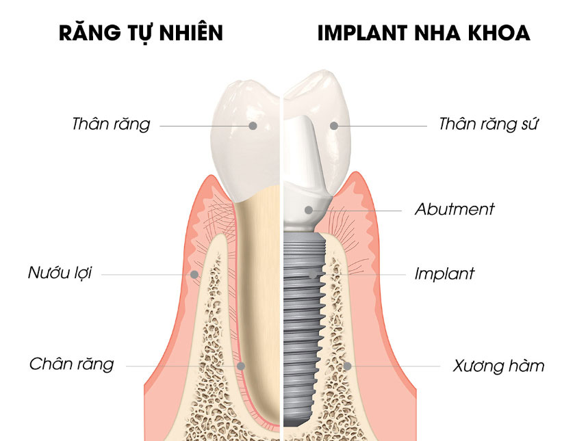 Hình ảnh so sánh răng thật và răng implant