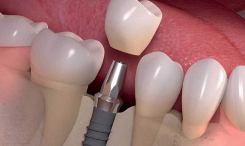 Phục hình răng sứ là bước cuối cùng để hoàn tất quá trình trồng răng implant