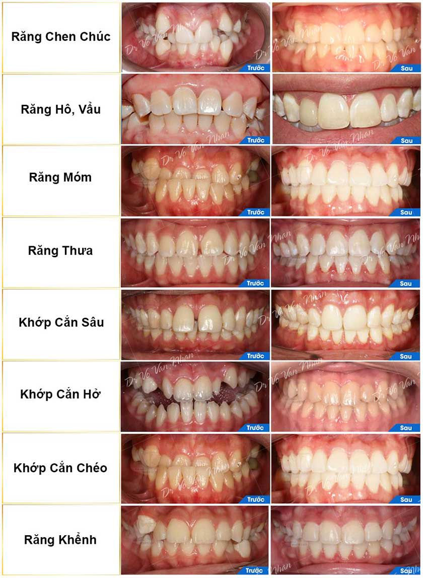 Những trường hợp nên niềng răng