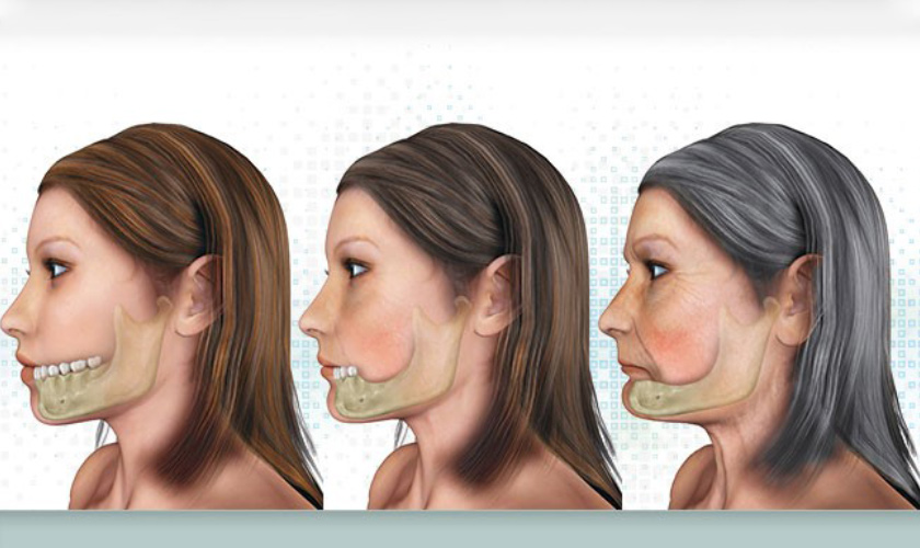 Ghép xương trong cấy ghép răng implant