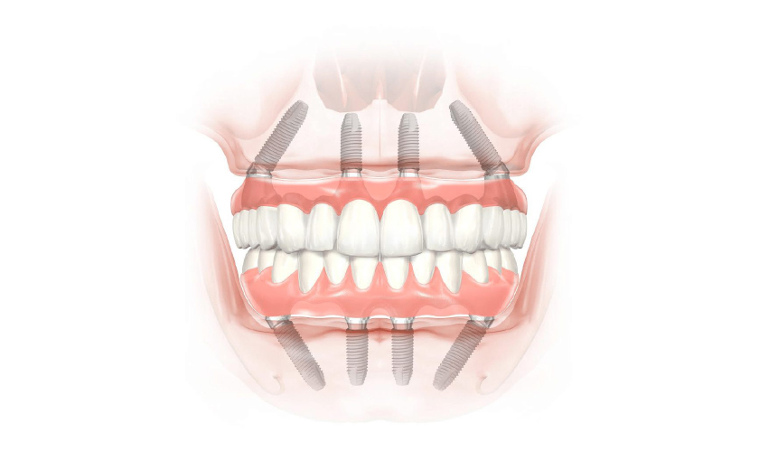Implant All on 4 - All on 6 – Giải pháp tiết kiệm chi phí và thời gian cho người mất răng toàn hàm
