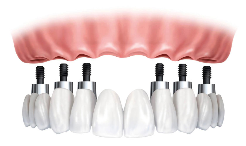 Kỹ thuật Implant All on 6