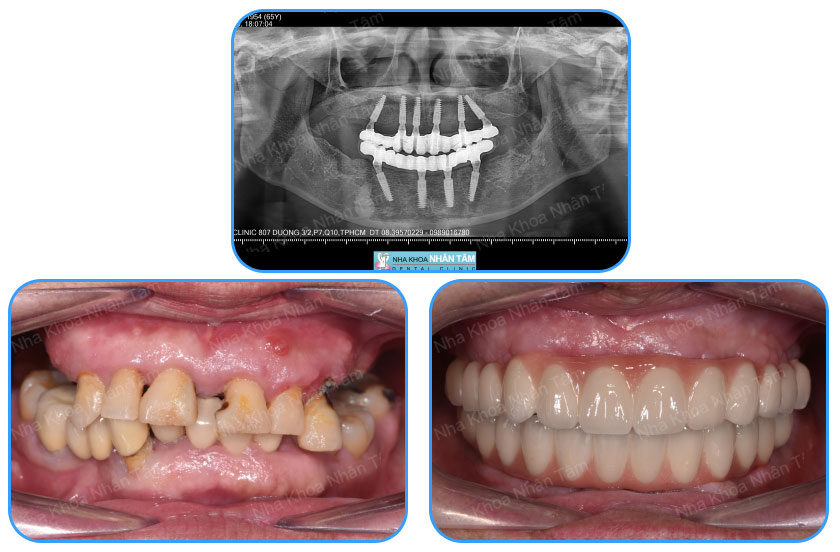Cấy ghép implant all on 4, all on 6 mang lại hàm răng hoàn hảo