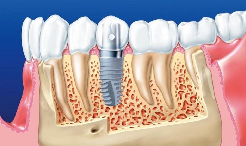 03 lời khuyên dinh dưỡng sau khi trồng răng implant