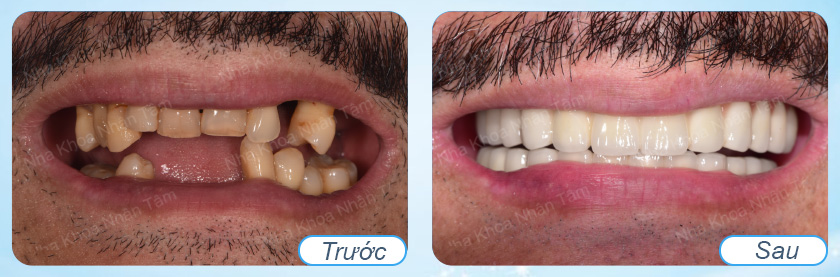 dich-vu-cay-ghep-implant-chat-luong-tai-quan-10