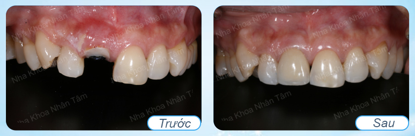 Mất một răng nên trồng răng sứ hay cấy ghép implant?