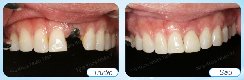 Mất một răng nên trồng răng sứ hay cấy ghép implant?