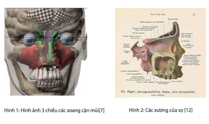 Nâng xoang hàm, ghép xương và cấy ghép implant