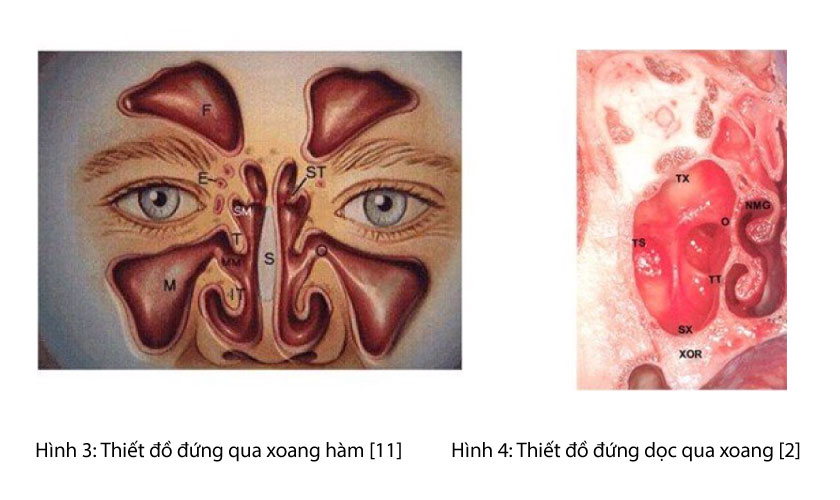 Nâng xoang hàm, ghép xương và cấy ghép implant