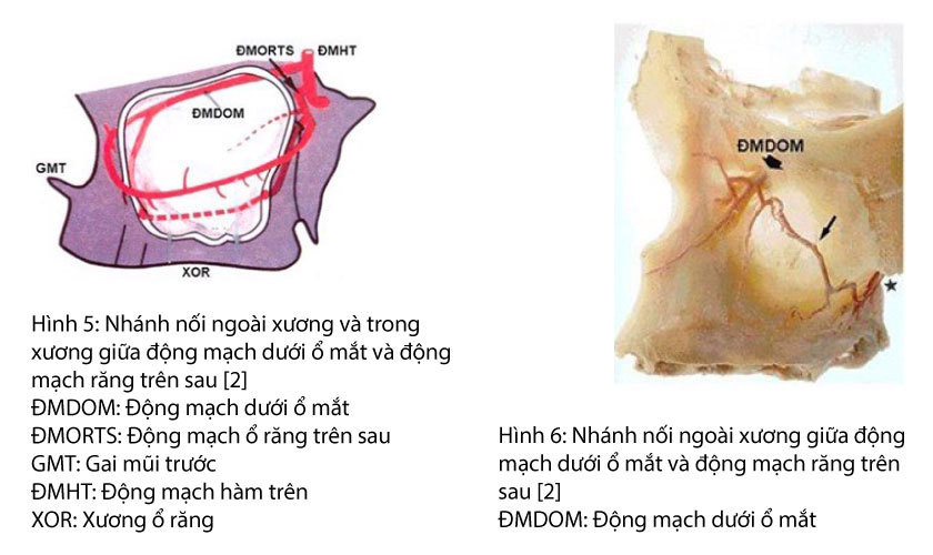 Nâng xoang hàm, ghép xương và cấy ghép implant