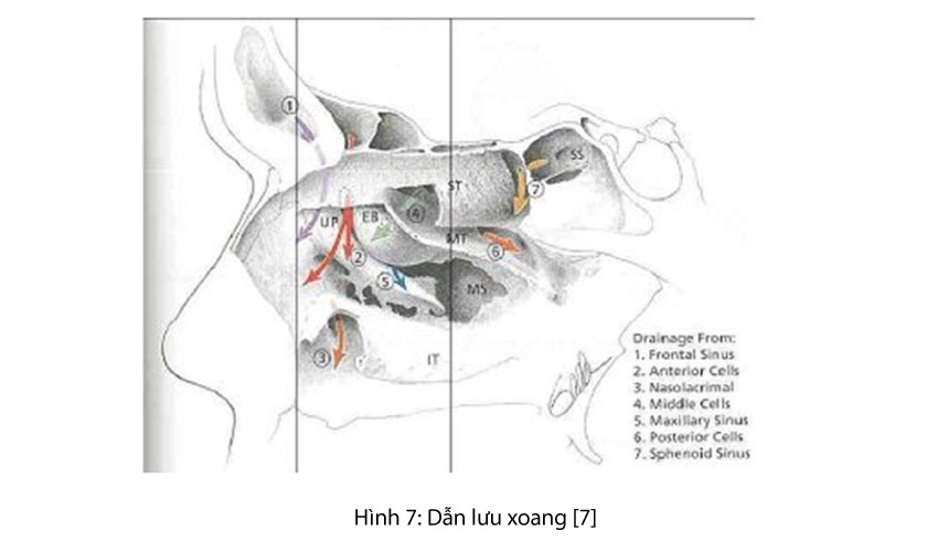 Nâng xoang hàm, ghép xương và cấy ghép implant