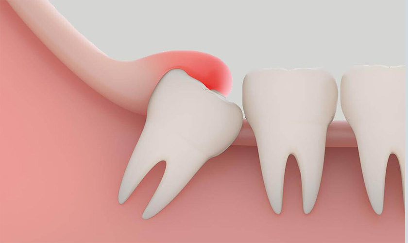 Những biểu hiện cụ thể nào cho thấy có thể gặp phải đau họng sau khi nhổ răng khôn?
