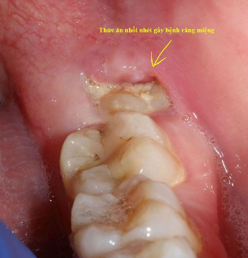Nhổ răng khôn có biến chứng gì không?