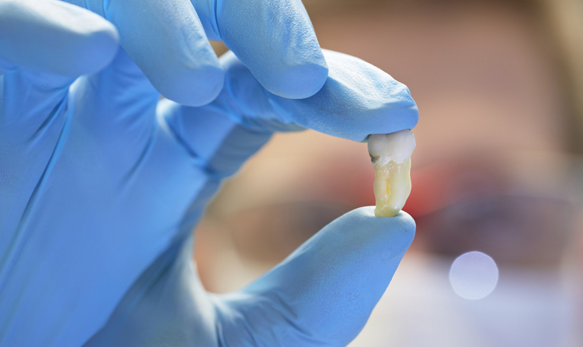 Nhổ răng khôn ở đâu uy tín, tốt nhất quận 3