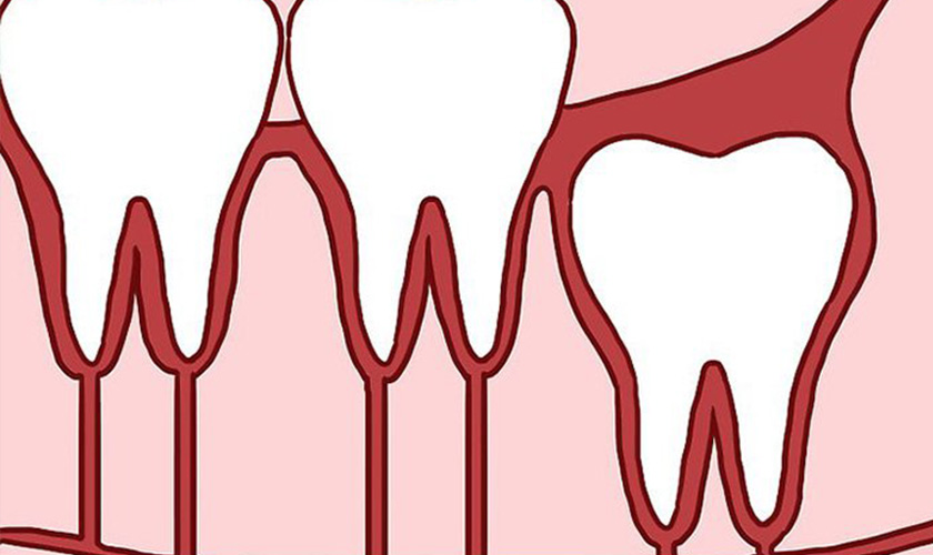 Phân biệt triệu chứng mọc răng khôn và bệnh răng miệng khác