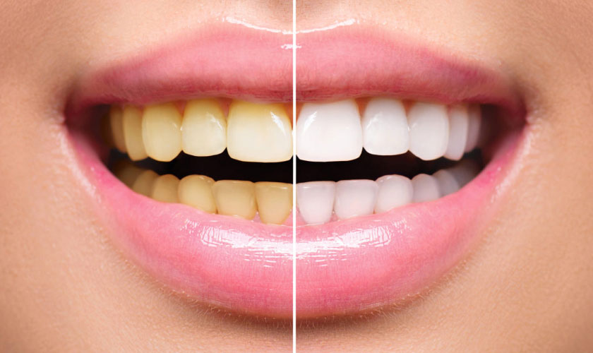 Chọn nha khoa tẩy trắng răng uy tín để mang lại hiệu quả cao nhất