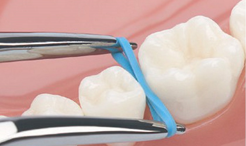 nha-khoa-nieng-rang-uy-tin-tai-quan-10