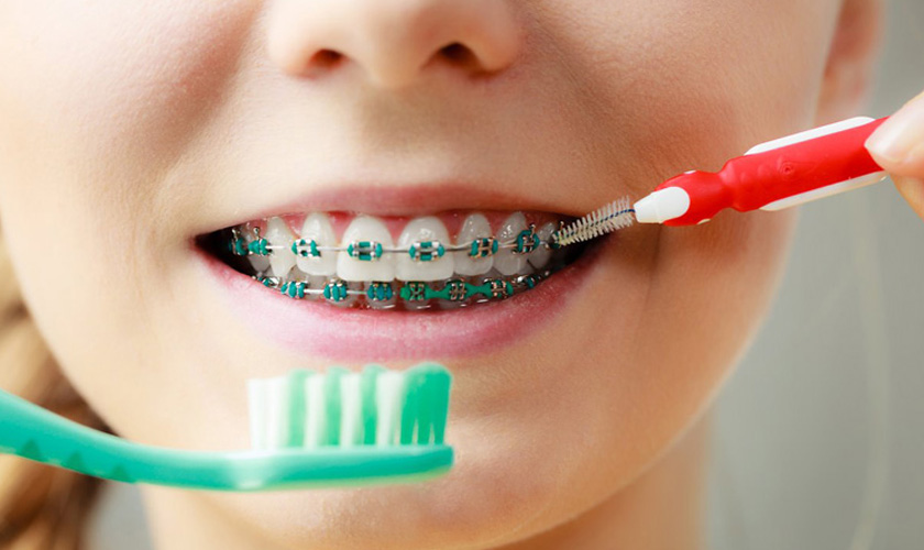 Nên chọn loại bàn chải nào khi niềng răng?