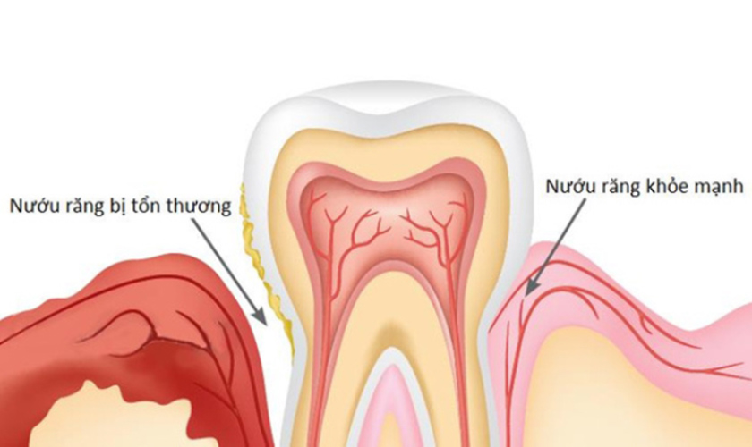 Nướu răng tổn thương và nướu răng khỏe mạnh