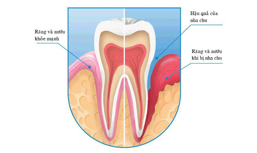 Nướu răng và thân răng bị tổn thương do nha chu