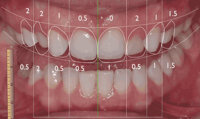 Phân tích màu sắc, tỉ lệ chuẩn giữa môi, nướu và răng