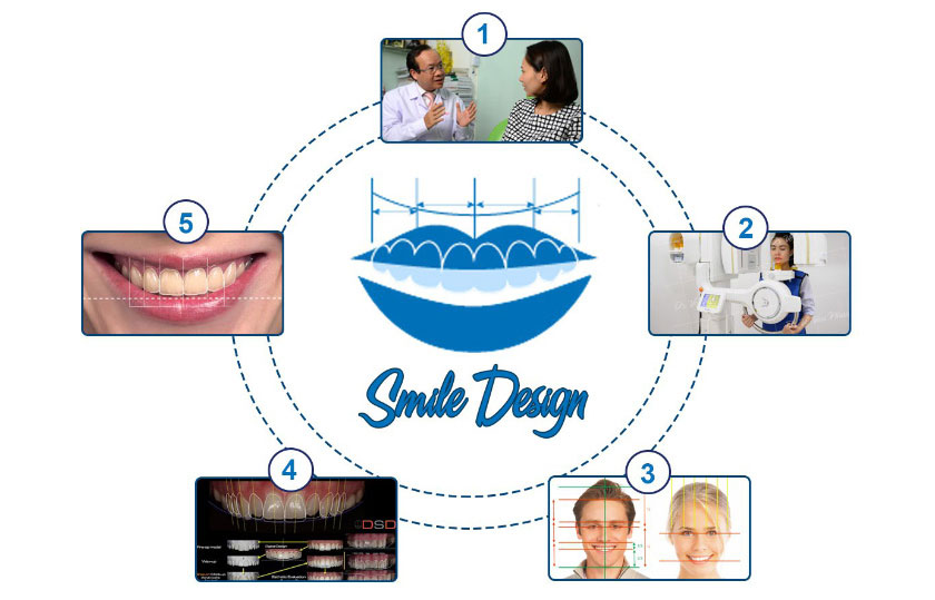 Quy trình thực hiện thiết kế nụ cười
