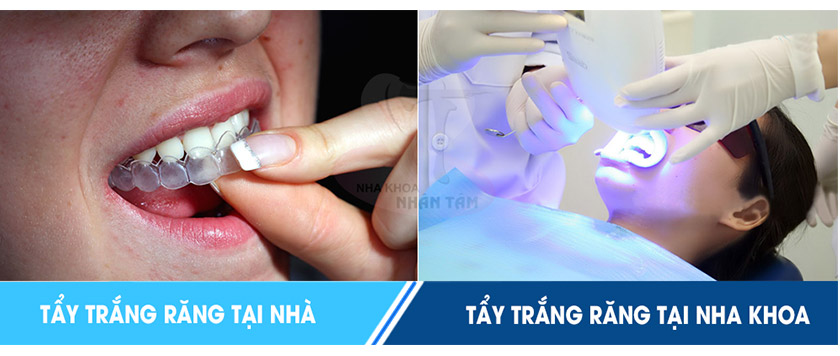 Hai phương pháp tẩy trắng răng phổ biến nhất hiện nay