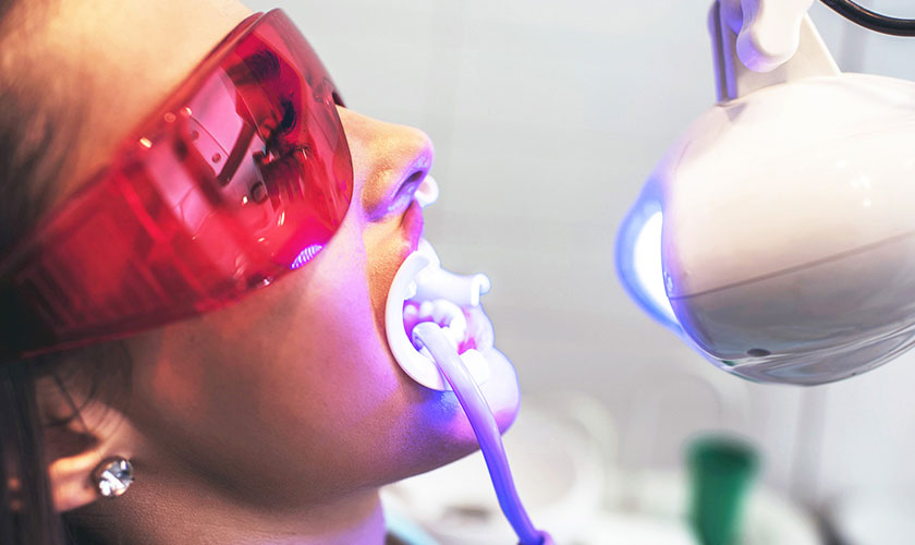 Tẩy trắng răng giá bao nhiêu còn tùy thuộc vào phương pháp tẩy trắng mà bạn lựa chọn