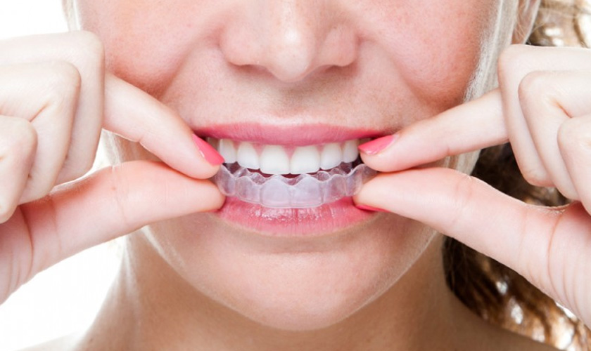 Tẩy trắng răng tại nhà giúp bạn tiết kiệm chi phí