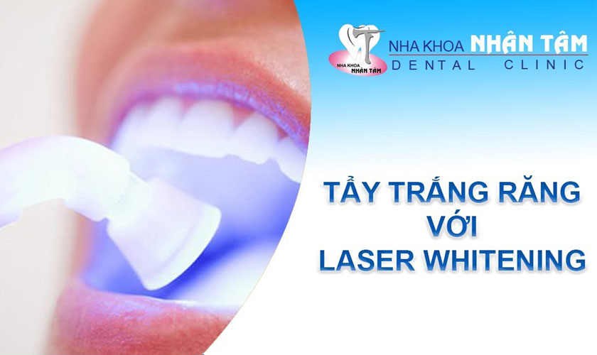 Nha khoa Nhân Tâm đang ứng dụng công nghệ Laser Whitening cho dịch vụ tẩy trắng răng
