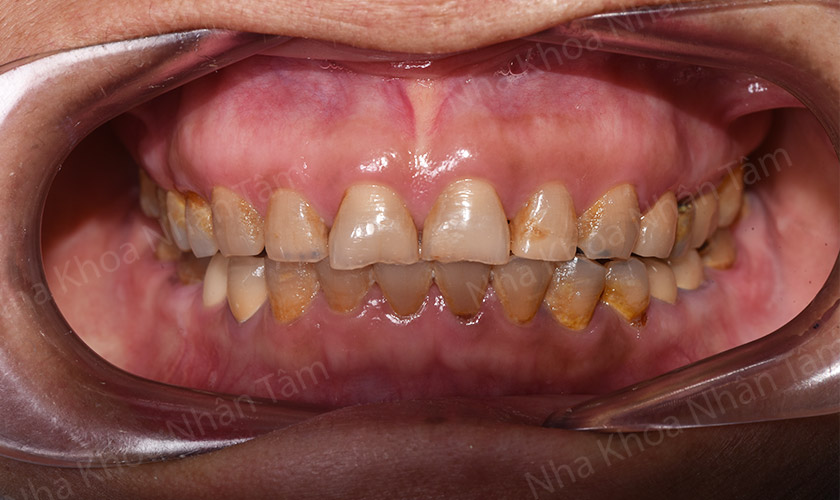 Răng bị nhiễm tetracycline