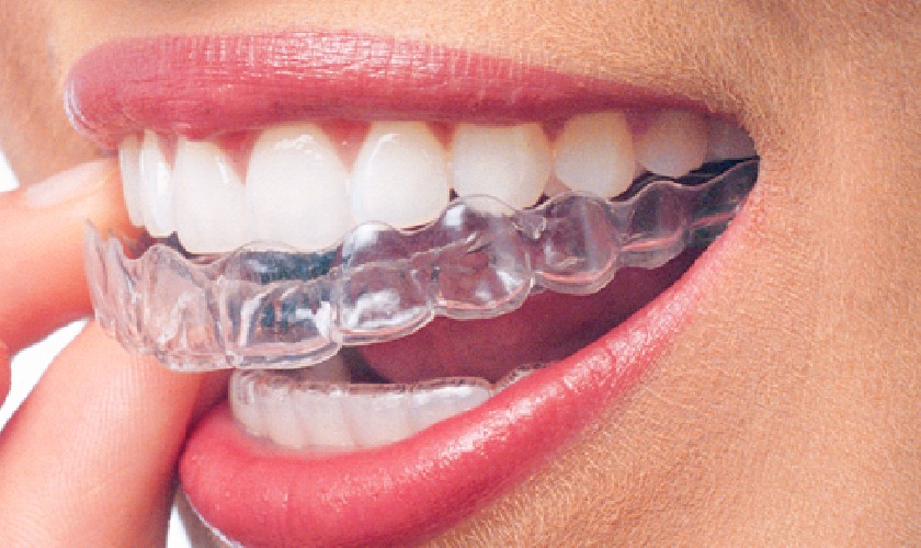 Tẩy trắng răng tại nhà giúp bạn tiết kiệm chi phí và chủ động được thời gian