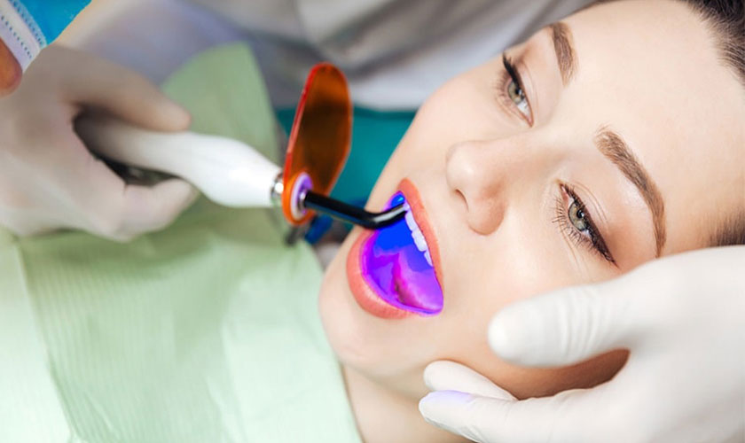 Đèn tẩy trắng răng là giải pháp được nhiều người lựa chọn Đèn tẩy trắng răng là giải pháp được nhiều người lựa chọn