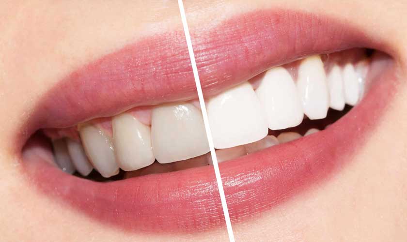 Cần thực hiện tẩy trắng răng đúng cách để đảm bảo hiệu quả, an toàn