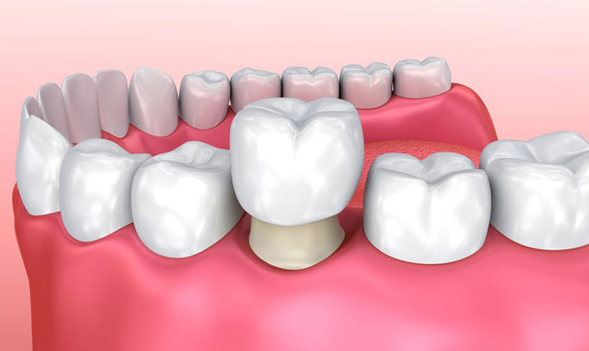 Bọc răng sứ phù hợp với những trường hợp răng bị nhiễm màu kháng sinh quá nặng Bọc răng sứ phù hợp với những trường hợp răng bị nhiễm màu kháng sinh quá nặng
