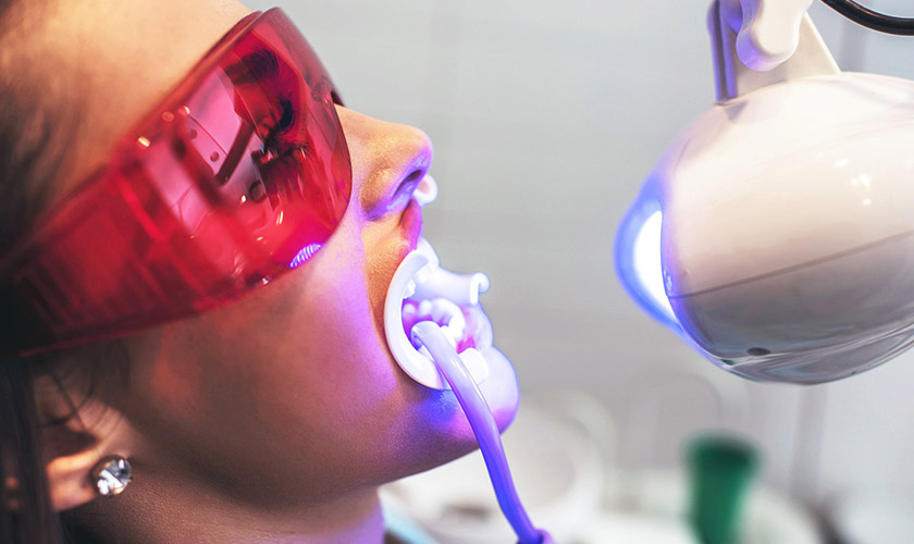 Tẩy trắng răng Laser Whitening Tẩy trắng răng Laser Whitening