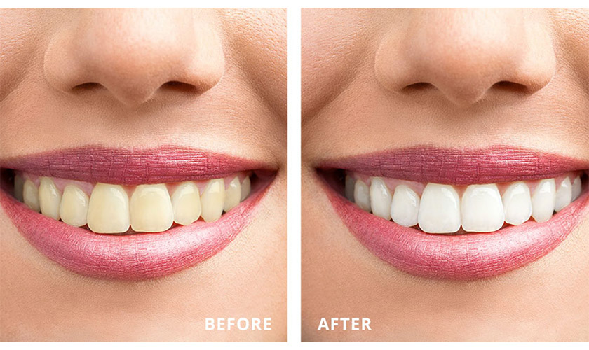 Tẩy trắng răng bằng công nghệ Laser Whitening giúp bạn nhanh chóng sở hữu hàm răng trắng sáng Tẩy trắng răng bằng công nghệ Laser Whitening giúp bạn nhanh chóng sở hữu hàm răng trắng sáng