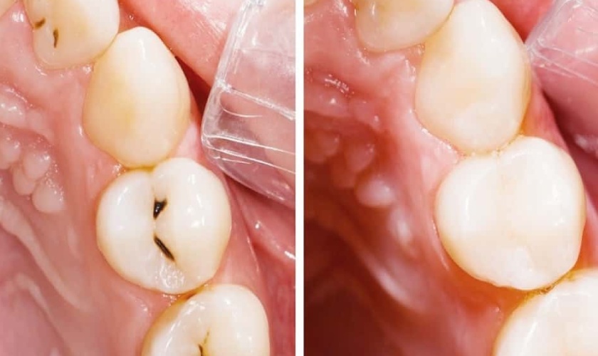 Trám răng thẩm mỹ sở hữu nhiều ưu điểm vượt trội