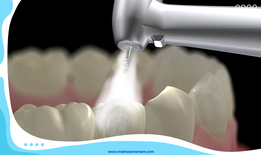 Trám răng thẩm mỹ