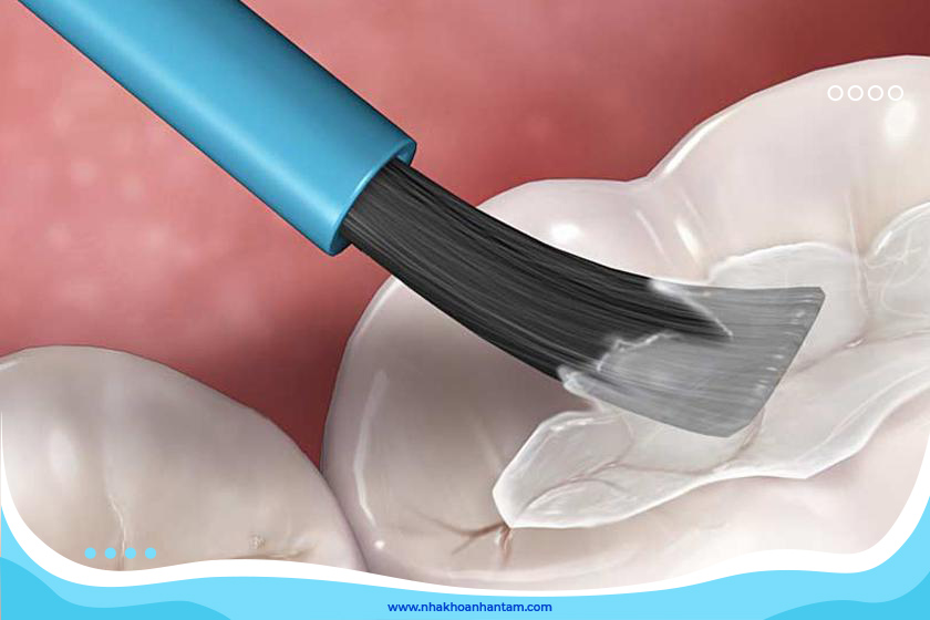 Vật liệu trám composite có tính thẩm mỹ cao