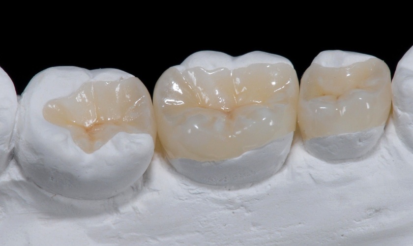 Kỹ thuật Inlay/Onlay có chi phí mắc hơn kỹ thuật trám thông thường