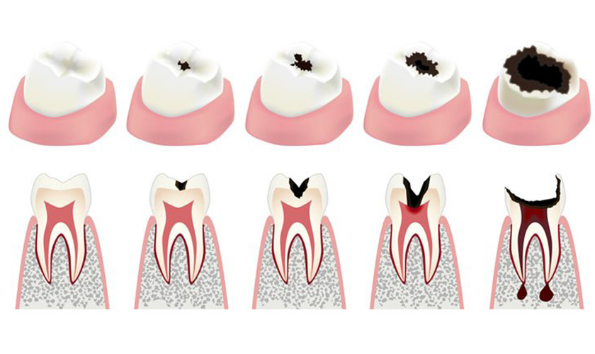 Sâu răng có thể dẫn đến tình trạng viêm tủy răng